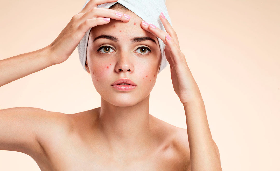 Limpieza Facial para Acné