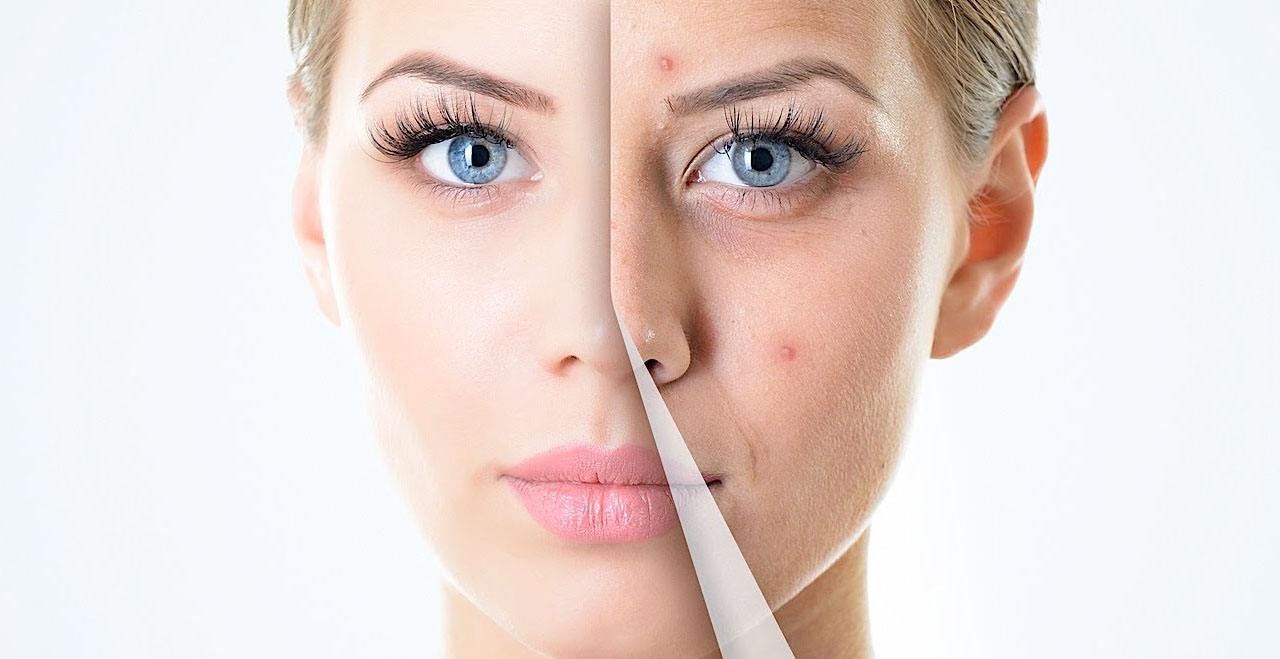Peeling para Pigmentación